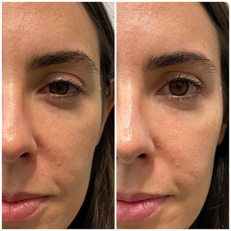 dr levy switzerland before and after fire and snow treatment 6min